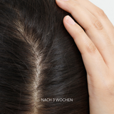 Set for Oily, Greasy Scalp